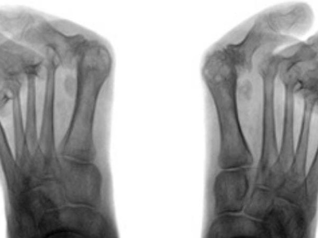 ¿Cómo afecta la artritis reumatoide a la salud de los pies?