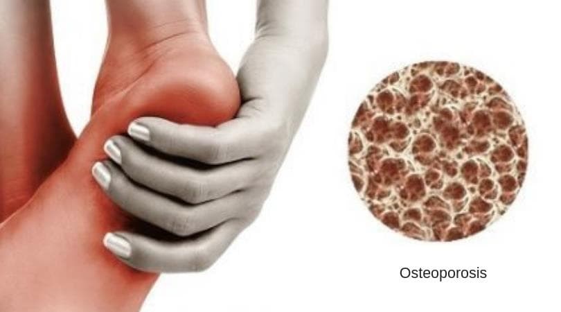 ¿Cómo afecta la osteoporosis a la salud de los pies?