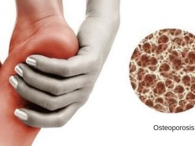 ¿Cómo afecta la osteoporosis a la salud de los pies?