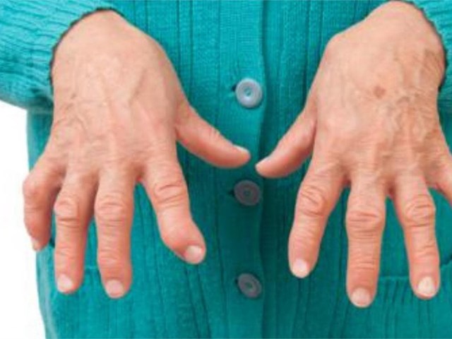 ¿Cómo ayuda la fisioterapia a pacientes con artritis reumatoide?