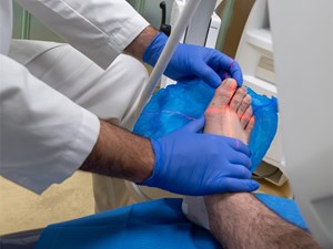 ¿Cómo saber si puedes someterte a una cirugía del pie?