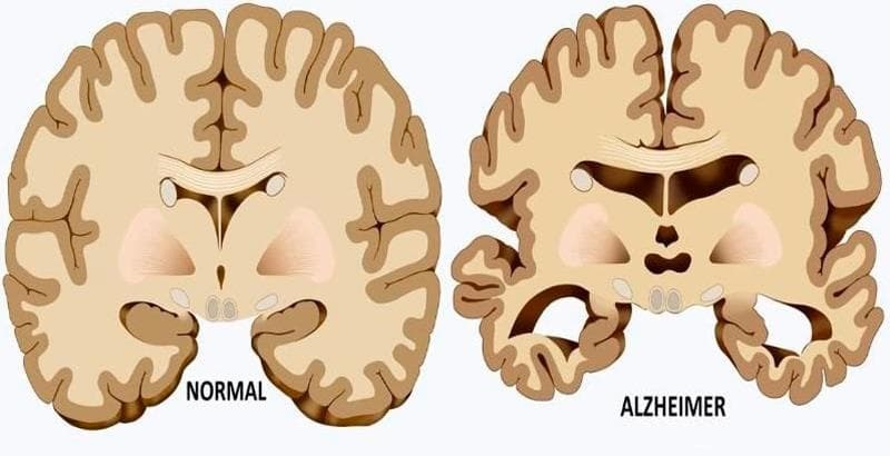Consejos para el cuidado de los pies en personas con Alzheimer