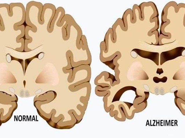 Consejos para el cuidado de los pies en personas con Alzheimer