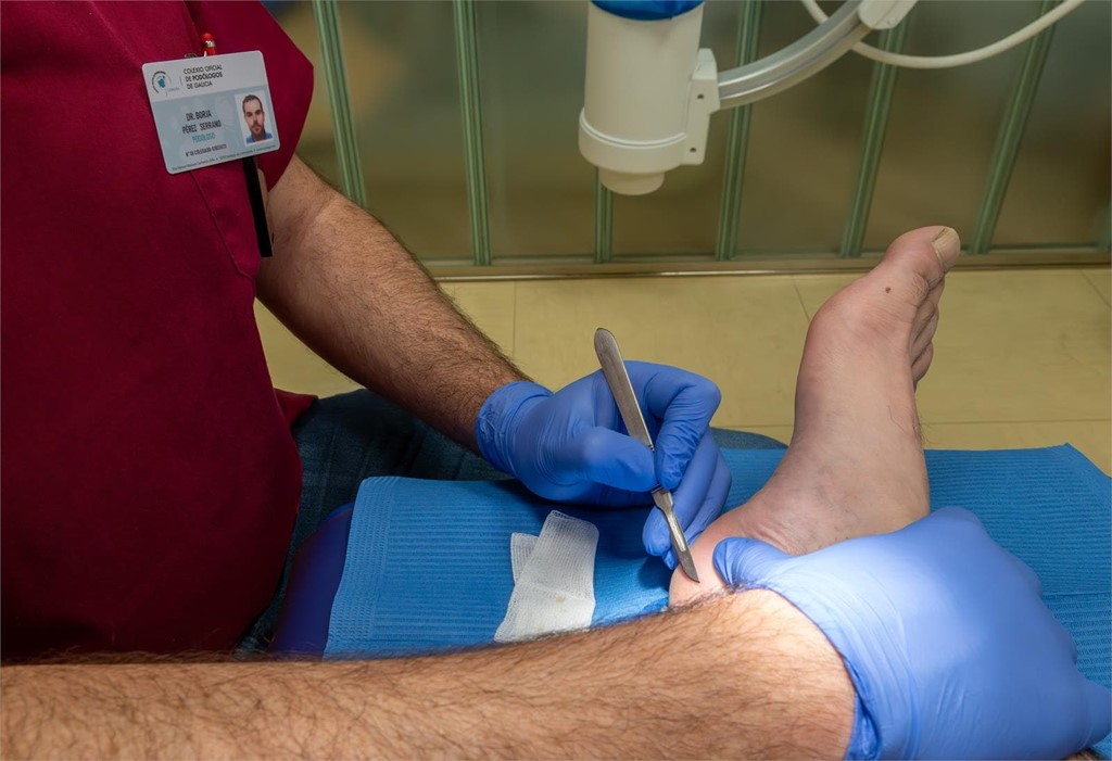 ¿Cuál es el mejor remedio para los callos de los pies?