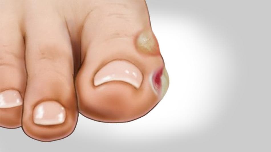 Ampollas en los pies ¿deben explotarse? Podólogos en Ourense