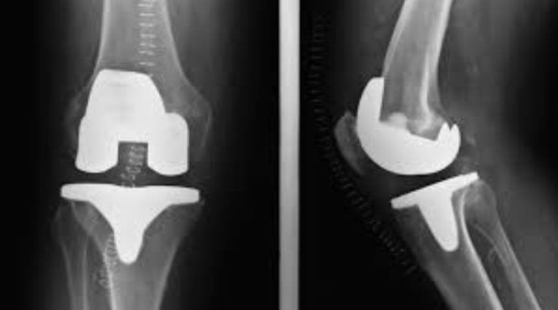 Fisioterapia tras una cirugía de prótesis de rodilla