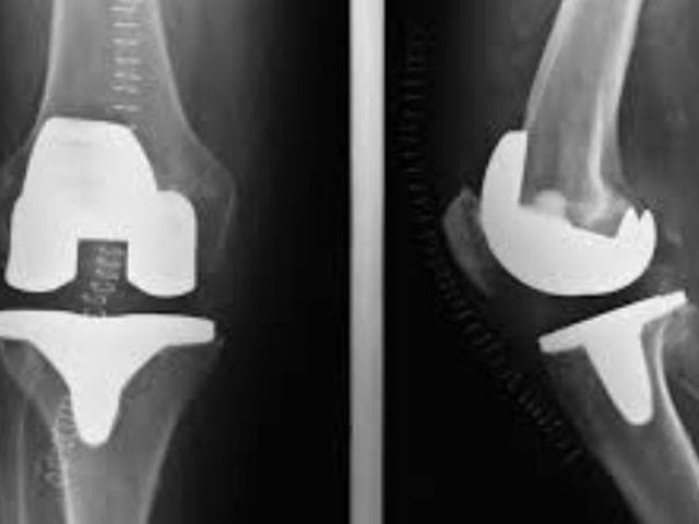 Fisioterapia tras una cirugía de prótesis de rodilla