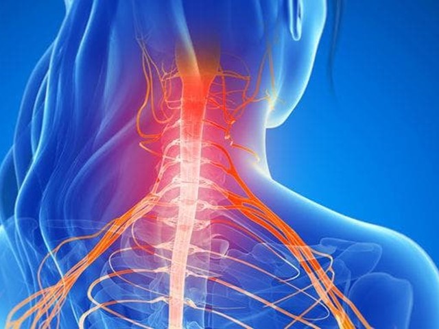 La importancia de la Fisioterapia en el tratamiento del Síndrome Cervicobraquial