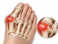 Mitos sobre el postoperatorio de la cirugía de juanetes