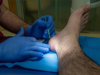 Papilomas: ¿Cómo evitarlos?