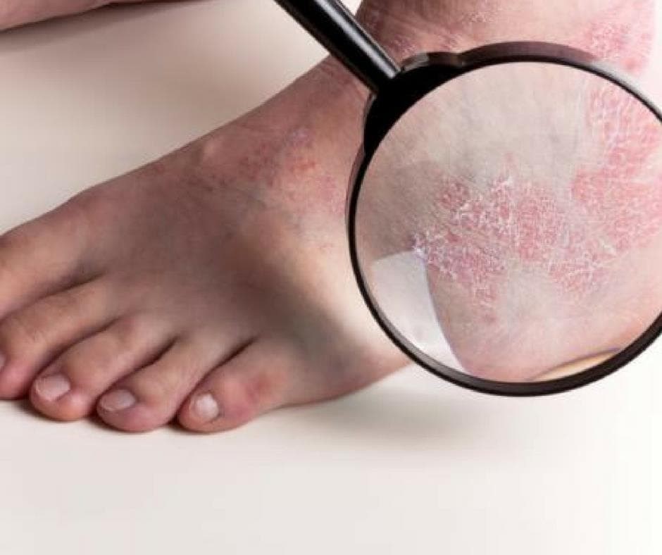 Psoriasis en los pies: tratamiento integral de podología, fisioterapia y traumatología