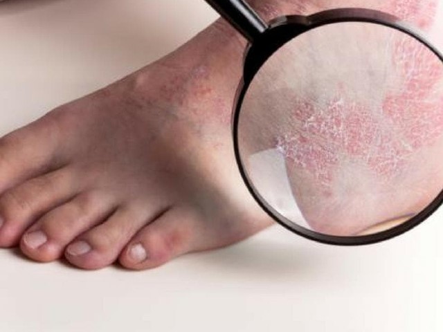 Psoriasis en los pies: tratamiento integral de podología, fisioterapia y traumatología