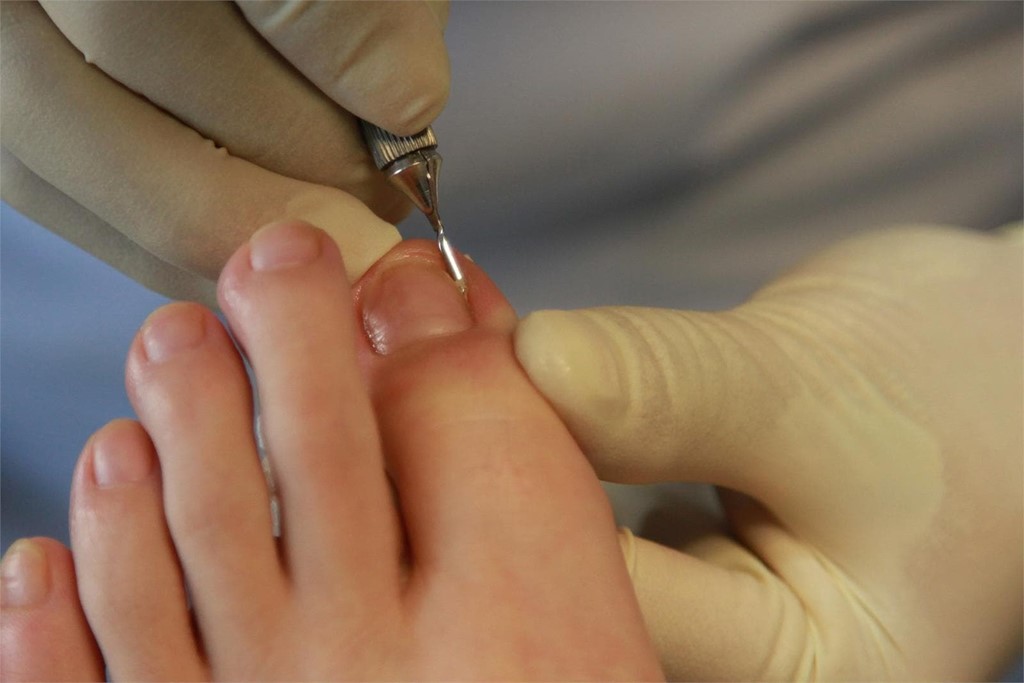 Tratamiento para las uñas encarnadas