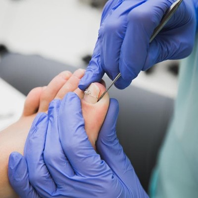Uñas encarnadas: ¿cómo se tratan?